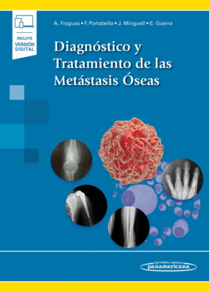 DIAGNOSTICO Y TRATAMIENTO DE LAS METASTASIS OSEAS